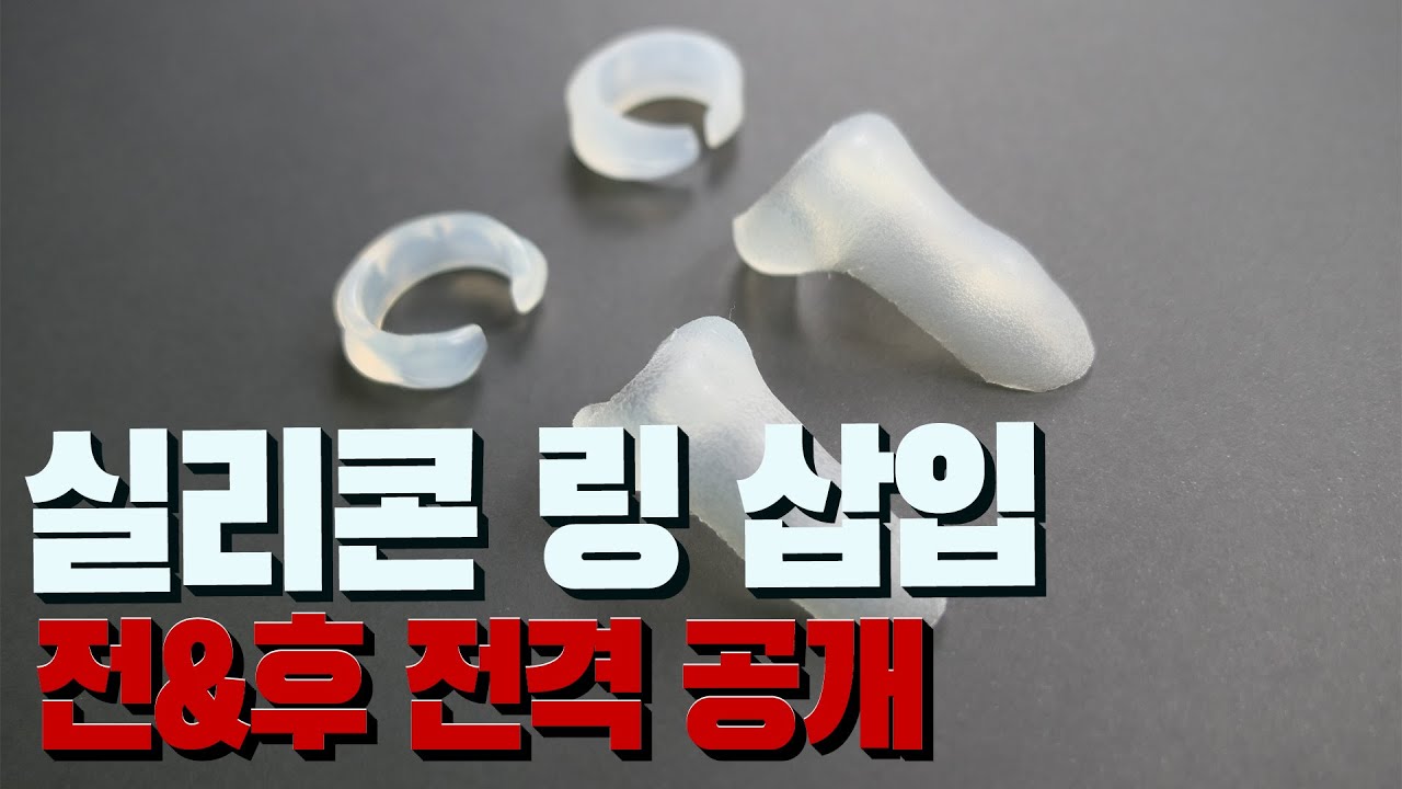 3D 영상으로 보는 실리콘보형물(C링, T링, 티링)의 수술방법과 수술전후 - Youtube