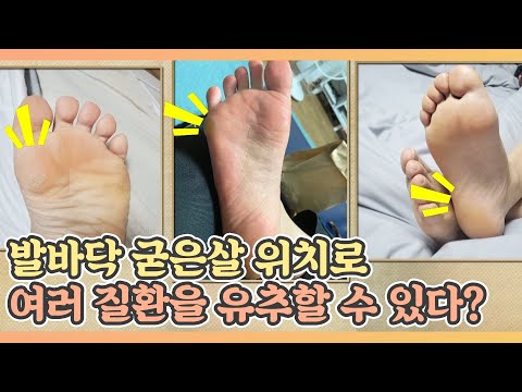 발바닥 굳은살 위치로 여러가지 질환을 유추할 수 있다? MBN 210423 방송