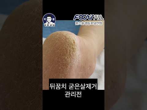 뒤꿈치 갈라진 굳은살 제거