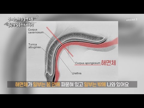 [굴곡형 임플란트의 특성] 충분한 이해를 통해 내린 결정은 좀 더 만족도가 높은 결과를 기대할 수 있습니다_(세움비뇨기과 박성훈원장) 팽창형임플란트/세조각보형물/발기부전수술