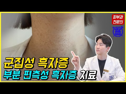 군집성 흑자증, 부분 편측성 흑자증, 일측성 흑자증의 레이저 치료를 알려드립니다. - 피부과전문의 닥터피부광