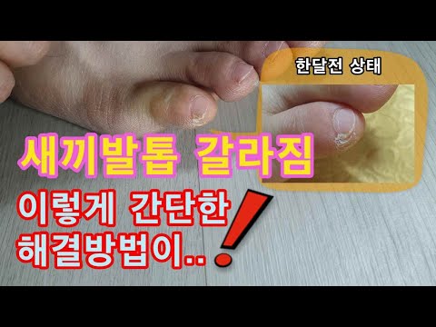 새끼발톱 갈라짐(며느리발톱).. 간단한 조치로, 불편함에서 해방되세요~