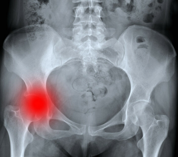 how-long-does-a-fractured-hip-take-to-heal-naturally