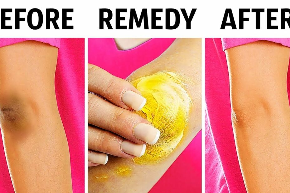 10 Natural Tricks To Remove Dark Knees And Elbows - Youtube