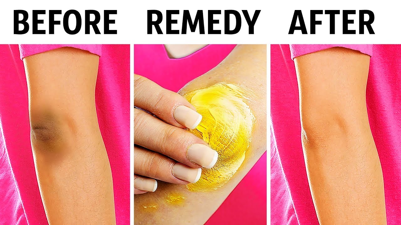 10 Natural Tricks To Remove Dark Knees And Elbows - Youtube