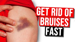 20 Effective Home Remedies For Bruises