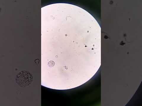 White blood cells vs Red blood cells in urine #laboratory #mls #microscope #medtechstudent #urine