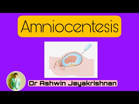 Amniocentesis | Dr Ashwin Jayakrishnan |