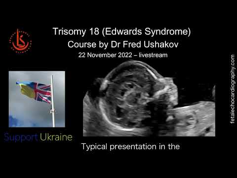 Trisomy 18 (Edwards Syndrome) Course: Special Fundraising Event for Ukraine Support. 22/11/22