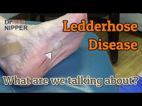 What is ledderhose disease? How is ledderhose disease treated? In the foot. (2021) Callus Tuesday