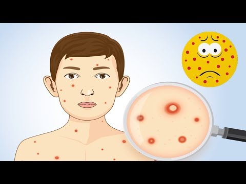 Chickenpox Do's  And Dont's ; Usefull Tips For Dealing With The illness